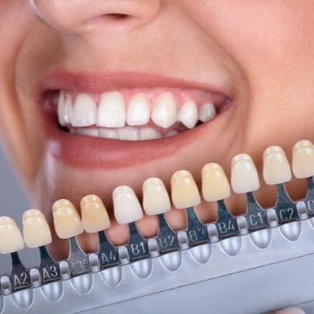 Valkoiset hampaath jälkeen